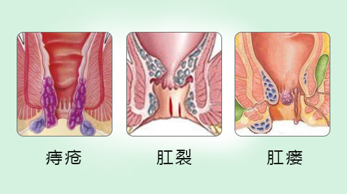 阜阳兆岐肛肠医院